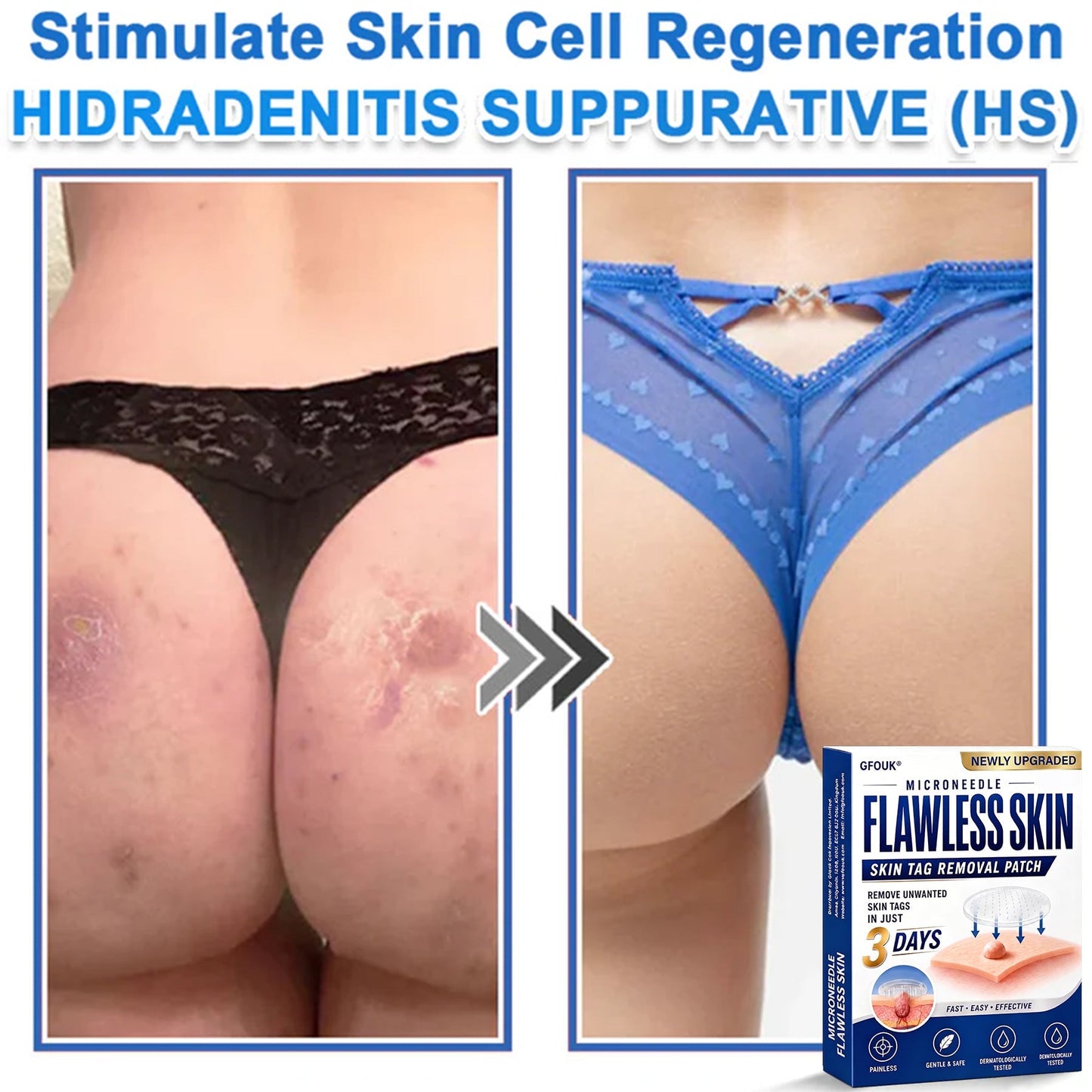 🧑‍⚕️GFOUK® 2026 Newly Upgraded 2-in-1 Microneedle Hydrocolloid Patches | Removes Raised Moles, Acne, Flat Warts, and Skin Tags | Improves Wrinkles, Scars, and Blemishes | Invisible Acne Patches for Face & Body