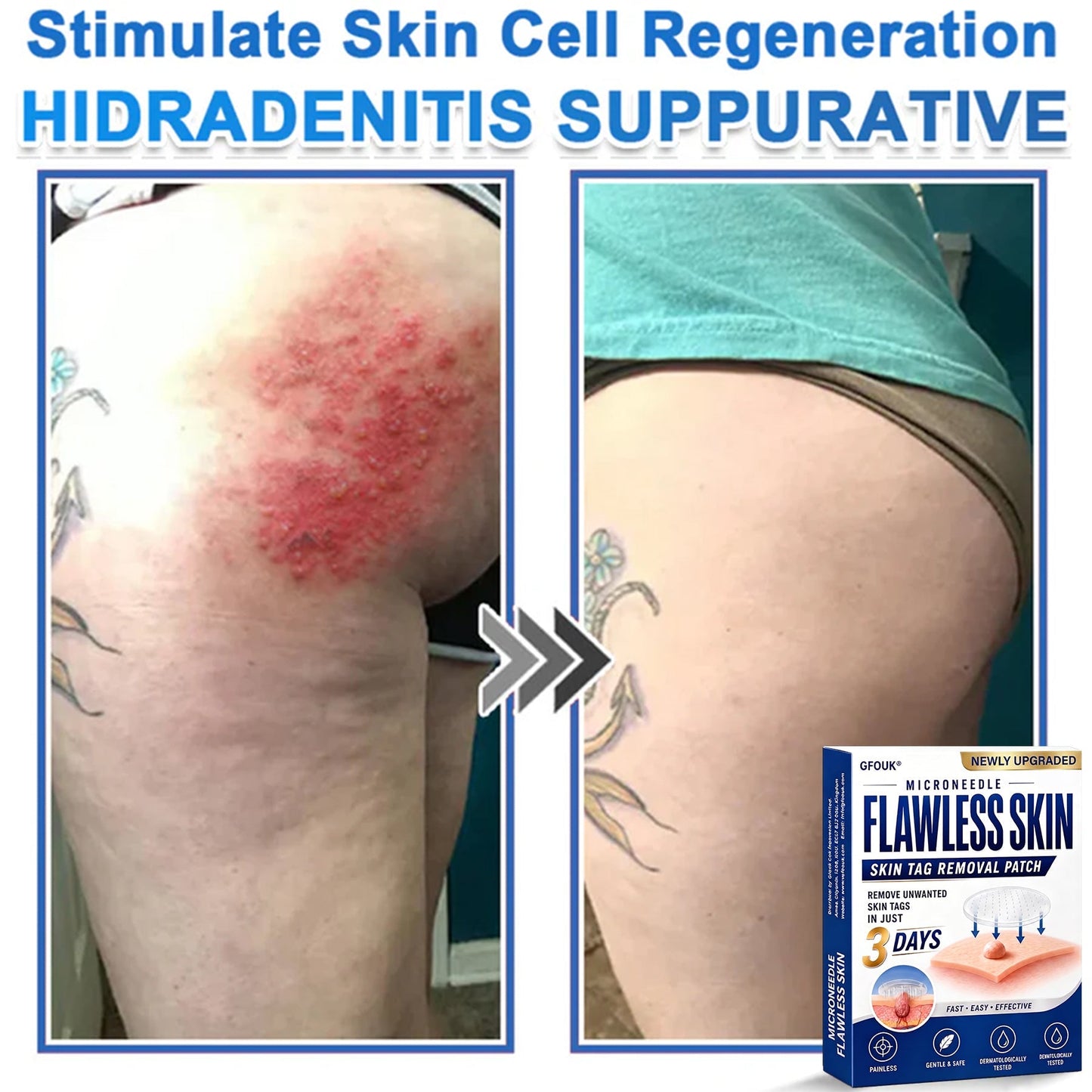 🧑‍⚕️GFOUK® 2026 Newly Upgraded 2-in-1 Microneedle Hydrocolloid Patches | Removes Raised Moles, Acne, Flat Warts, and Skin Tags | Improves Wrinkles, Scars, and Blemishes | Invisible Acne Patches for Face & Body