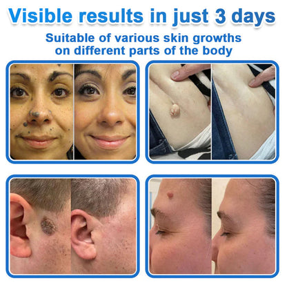 🧑‍⚕️GFOUK® 2026 Newly Upgraded 2-in-1 Microneedle Hydrocolloid Patches | Removes Raised Moles, Acne, Flat Warts, and Skin Tags | Improves Wrinkles, Scars, and Blemishes | Invisible Acne Patches for Face & Body