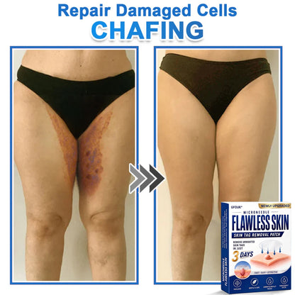 🧑‍⚕️GFOUK® 2026 Newly Upgraded 2-in-1 Microneedle Hydrocolloid Patches | Removes Raised Moles, Acne, Flat Warts, and Skin Tags | Improves Wrinkles, Scars, and Blemishes | Invisible Acne Patches for Face & Body