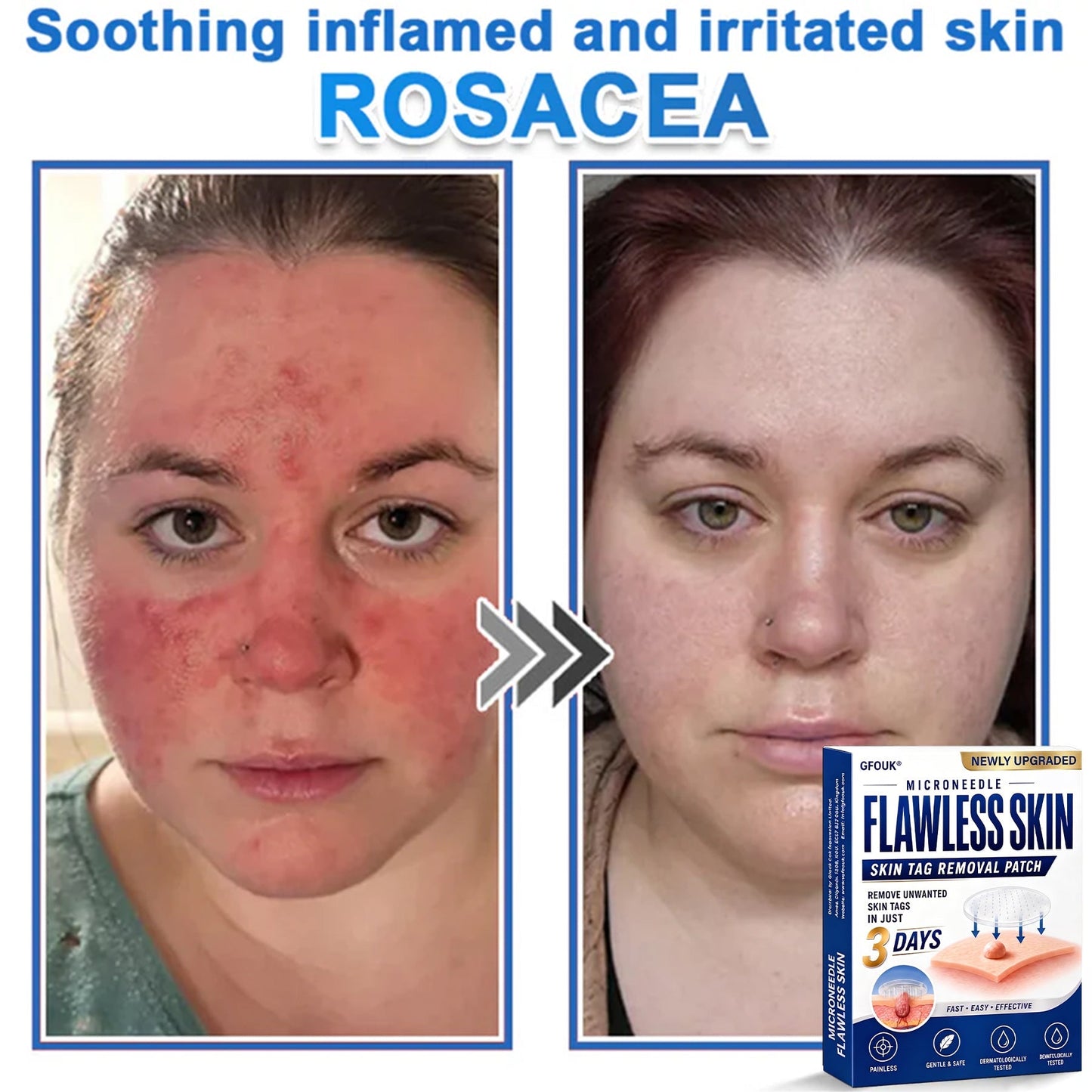 🧑‍⚕️GFOUK® 2026 Newly Upgraded 2-in-1 Microneedle Hydrocolloid Patches | Removes Raised Moles, Acne, Flat Warts, and Skin Tags | Improves Wrinkles, Scars, and Blemishes | Invisible Acne Patches for Face & Body