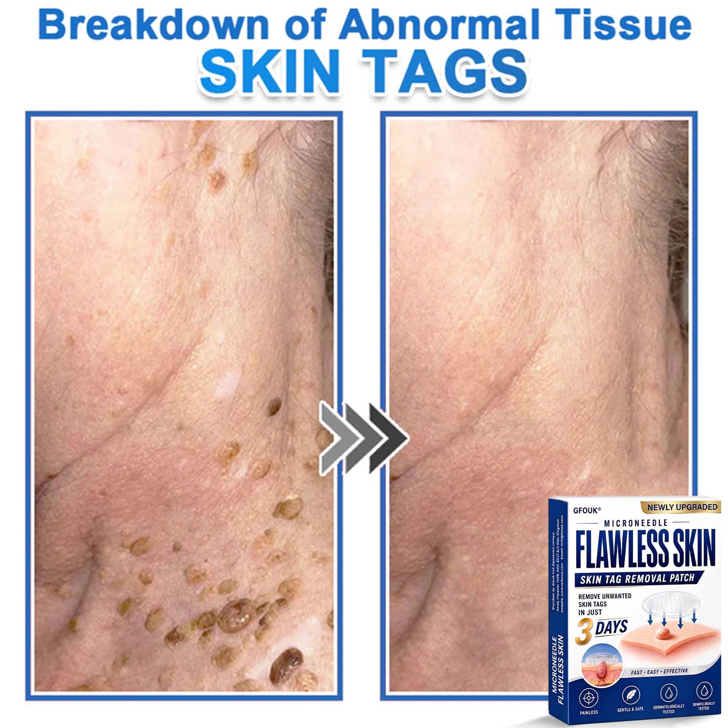 🧑‍⚕️GFOUK® 2026 Newly Upgraded 2-in-1 Microneedle Hydrocolloid Patches | Removes Raised Moles, Acne, Flat Warts, and Skin Tags | Improves Wrinkles, Scars, and Blemishes | Invisible Acne Patches for Face & Body