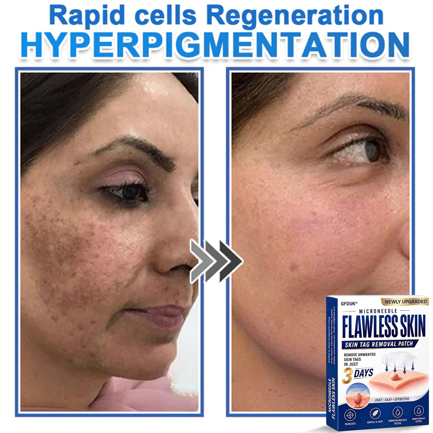 🧑‍⚕️GFOUK® 2026 Newly Upgraded 2-in-1 Microneedle Hydrocolloid Patches | Removes Raised Moles, Acne, Flat Warts, and Skin Tags | Improves Wrinkles, Scars, and Blemishes | Invisible Acne Patches for Face & Body