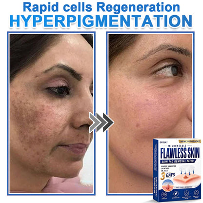 🧑‍⚕️GFOUK® 2026 Newly Upgraded 2-in-1 Microneedle Hydrocolloid Patches | Removes Raised Moles, Acne, Flat Warts, and Skin Tags | Improves Wrinkles, Scars, and Blemishes | Invisible Acne Patches for Face & Body
